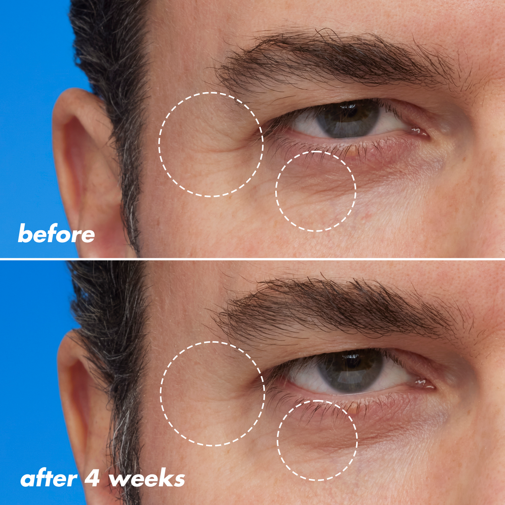 Fine Line and Wrinkles Before and After Using Retinoid Face Oil for Four Weeks